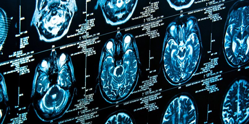 neuropanplaste freedom tomografia mozgu proti bolesti neuropanplaste freedom tomografia mozgu proti bolesti